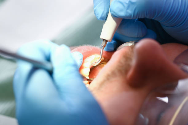 Best Emergency Dentist for Lost Fillings or Crowns in Cotati, CA